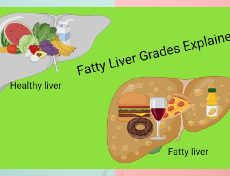 Fatty Liver Grades